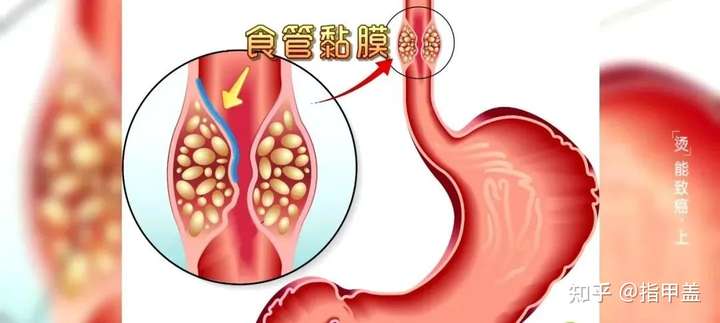 有人说长期吃烫的东西会得食道癌,是真的么?