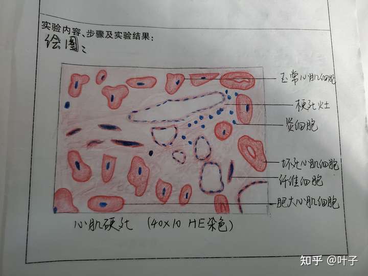 求有没有脾梗死,心肌梗死病理学绘图?