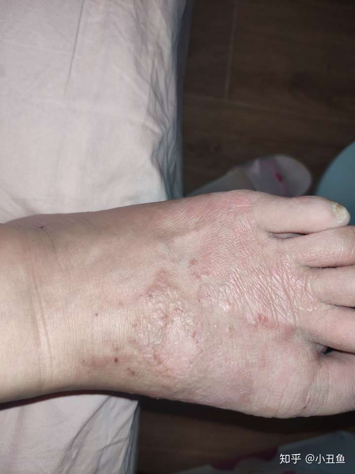 连续四年,每到夏天双脚脚面就犯湿疹,有没有办法根治?