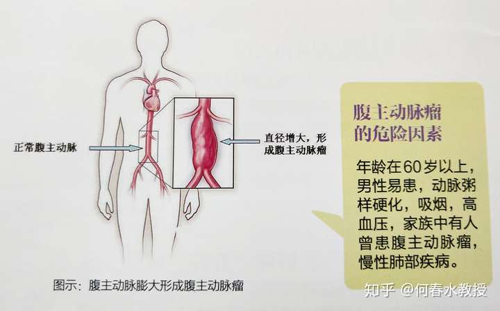 沉默的杀手腹主动脉瘤