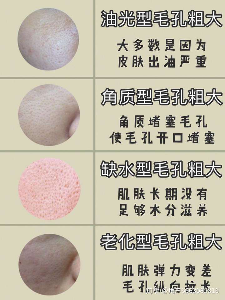 分为油光型毛孔粗大,角质型毛孔粗大 ,缺水型毛孔粗大,老化型毛孔粗大