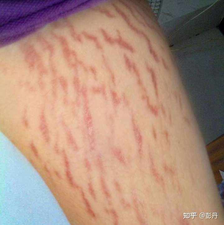 满条腿长了肥胖纹,要死了,男朋友别想找了,是男的都介意吗?