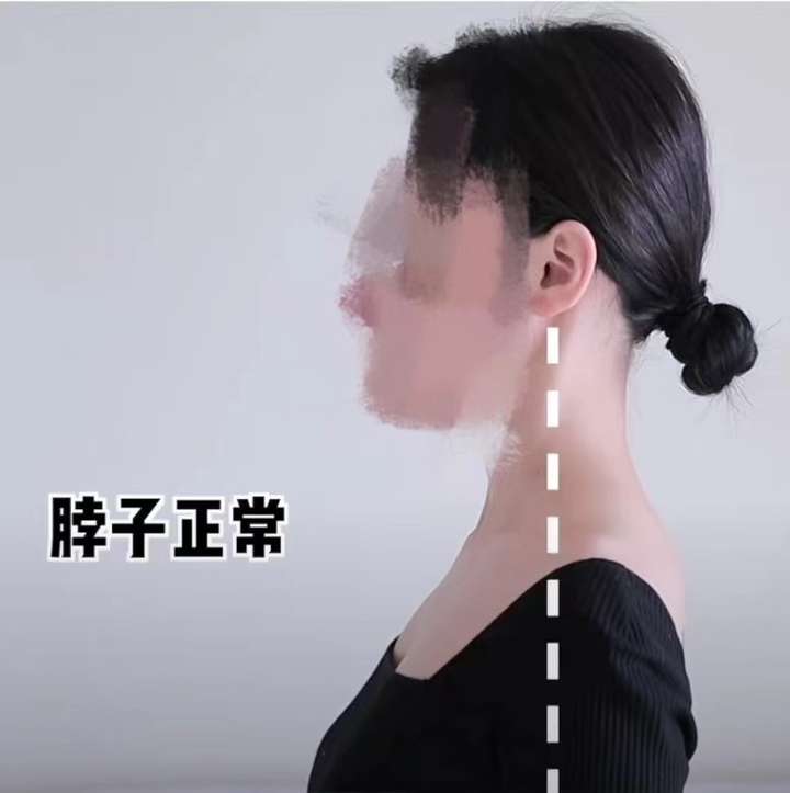 脖子前倾怎么矫正