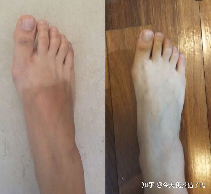 脚晒黑了怎么恢复