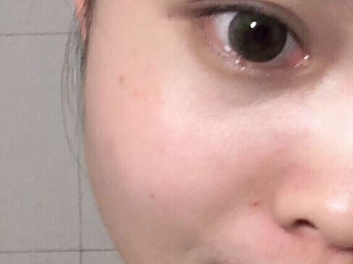 脸部毛周角化症怎么破?