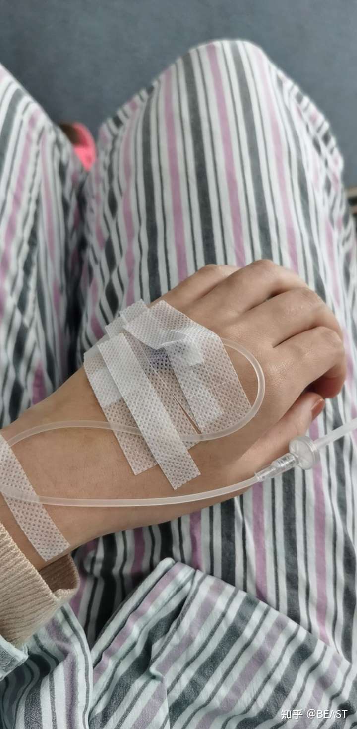 13,拆了纱布清洗伤口 早晨拆纱布,有点水肿,冷敷以后就明显没这么