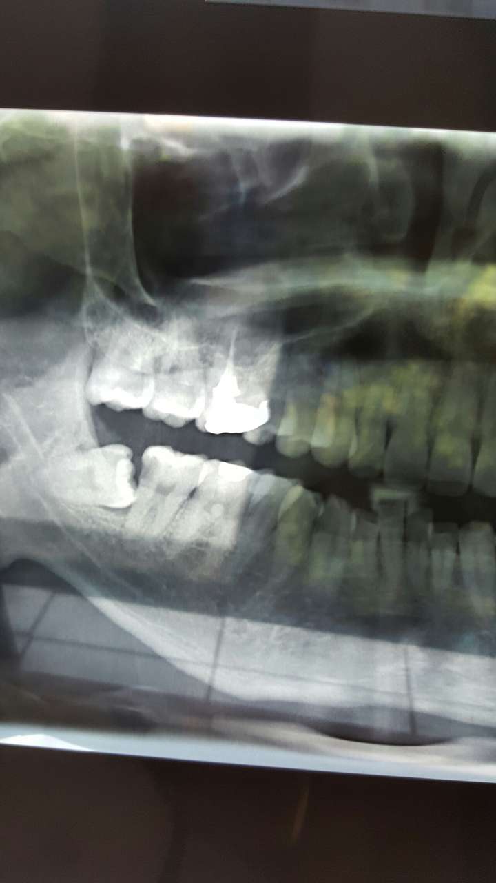 拔智齿有多痛?