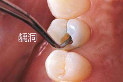 犬齿臼齿智齿六龄齿龋齿你分得清吗