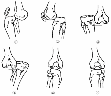 紧贴关节囊走行于股二头肌肌腱和腓肠肌肌腱之间,沿腓骨头后面并绕过