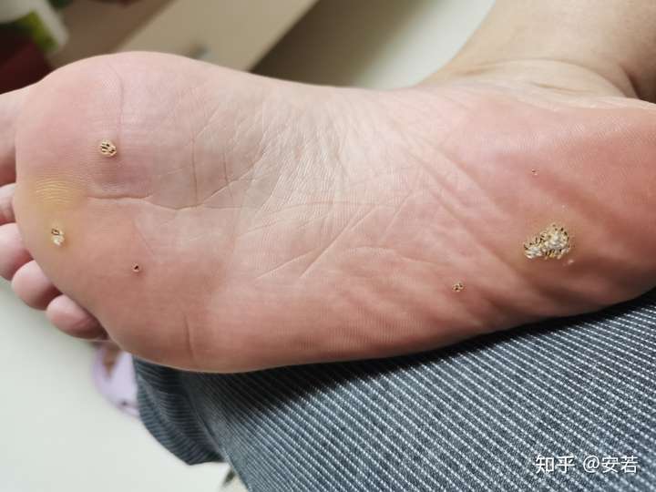 冷冻后,结痂,但不脱落,跖疣?
