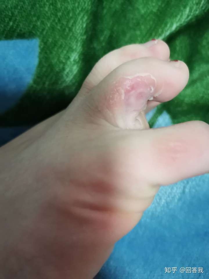 脚上有鸡眼怎么治?