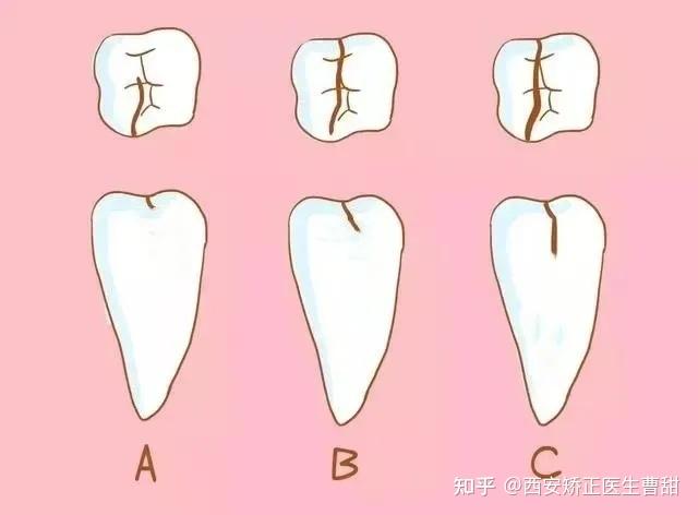 牙隐裂有哪些表现?致病原因是什么?该如何预防和治疗呢?