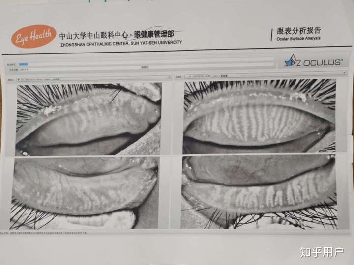 刚刚满21岁,检查出干眼症,下睑板腺部分萎缩,该怎么办?