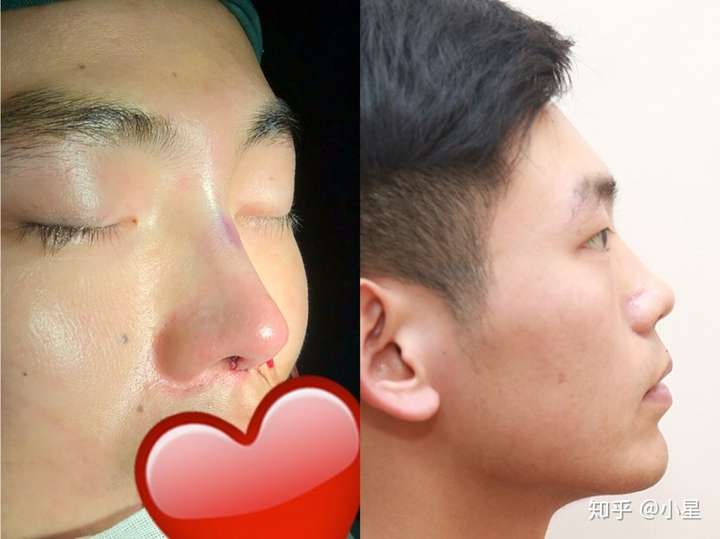 反正一般来说男性鼻部强调的是硬朗笔直的感觉,女性要求线条柔和,在