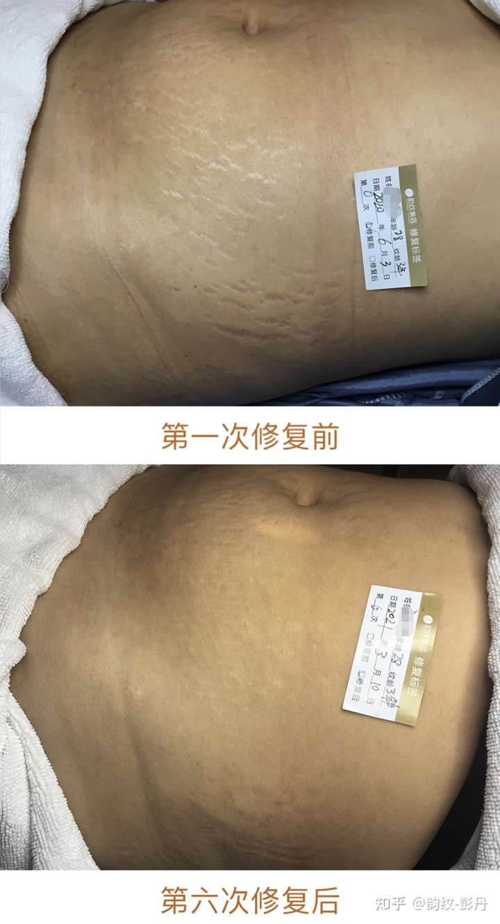 产后妊娠纹该怎么消除?各位孕妈有什么好的建议吗?