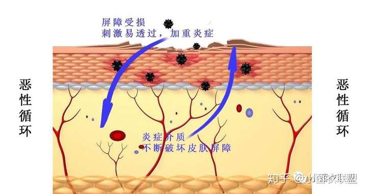 皮肤屏障功能受损和炎症反应示意图