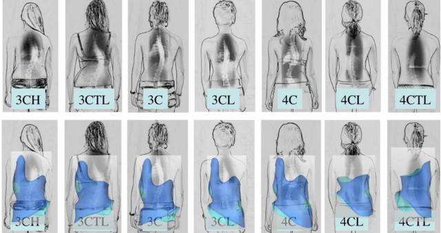 施罗特将脊柱侧弯细分成了七个种类,每一种也会对应有效的施罗特软