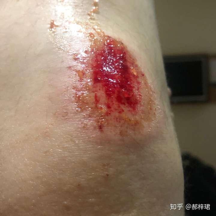 这是骑自行车摔倒后的膝盖,有一些渗出