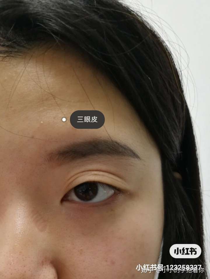 双眼皮忽然变成三眼皮怎么办