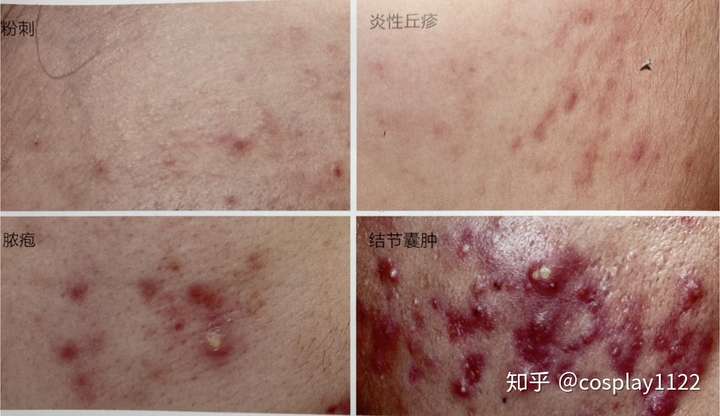脸上长粉刺痘痘怎么办?