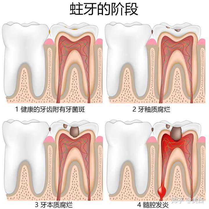 蛀牙产生的原因是什么如何预防和应对