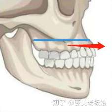 正颌手术可以弥补上下颌骨发育不足的问题吗?