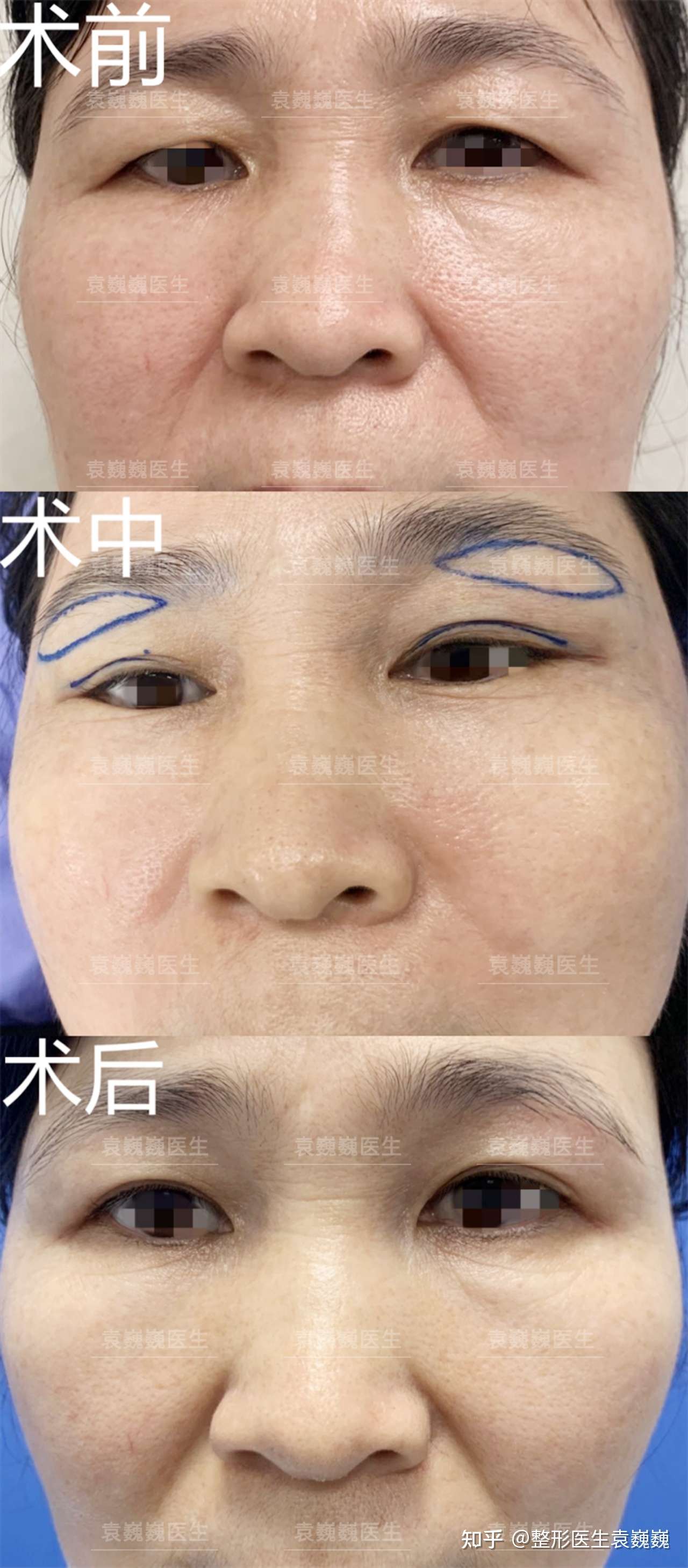 深圳提眉案例分享
