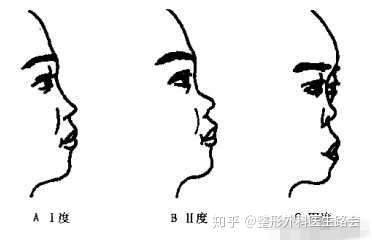 鞍鼻原来就是塌鼻梁之前了解太少了