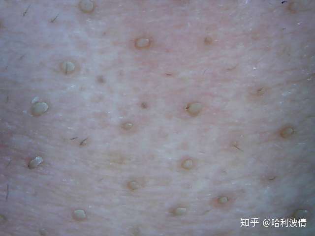 这是我用女朋友的皮肤检测仪拍的鼻子上的黑头,颗颗饱满,诱人,欲滴.