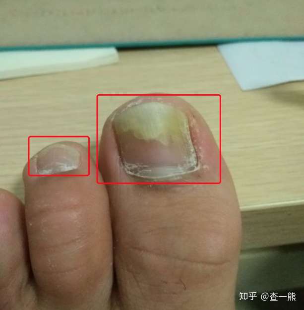 根据症状来看像是真菌感染引起的灰指甲,症状表现为甲分离,具体症状可