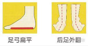 怎么区别足内翻和足外翻?