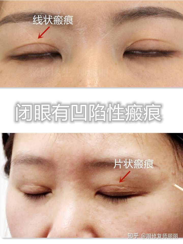 双眼皮术后出现严重的瘢痕都是因为皮下组织去除过多,引起的瘢痕增生