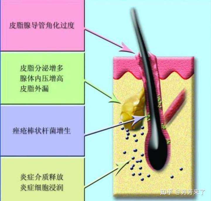 痘痘的发病机理还有有以下四个特点: 1,毛囊皮脂腺导管口的角化,阻塞