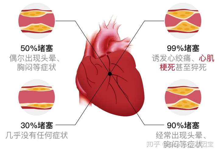「心肌梗死」的发病原因包括哪些,有哪些先兆症状,如何预防?