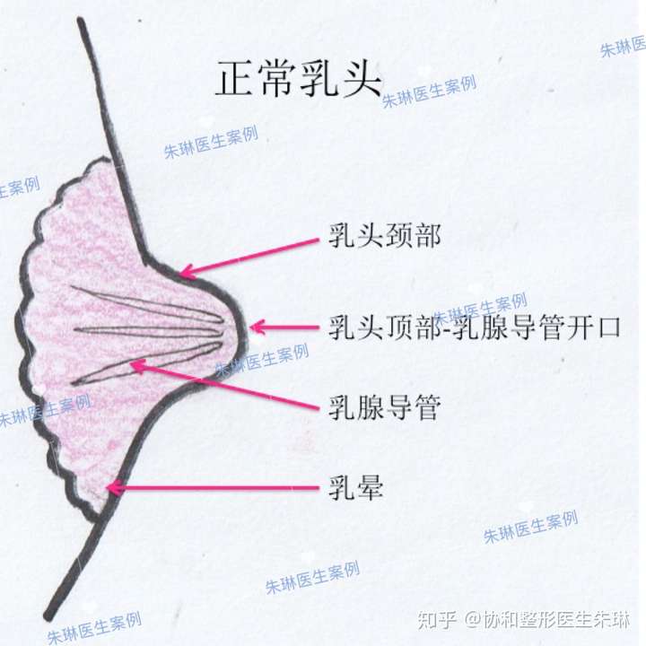 有人去做过乳头内陷矫正手术吗?