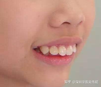 牙凸就是牙齿前倾导致嘴部突出.