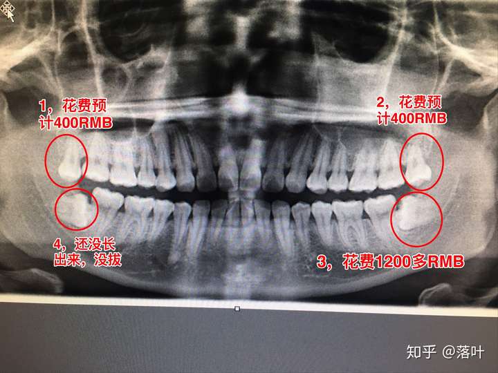 拔智齿有多痛?