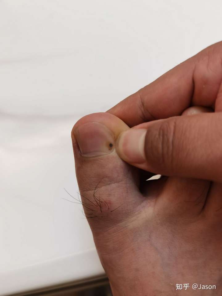 左右脚的大拇指,分别长了一个黑斑,位置相同,是黑色素