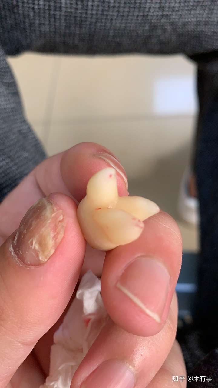 智齿究竟能长多大?或者多怪?