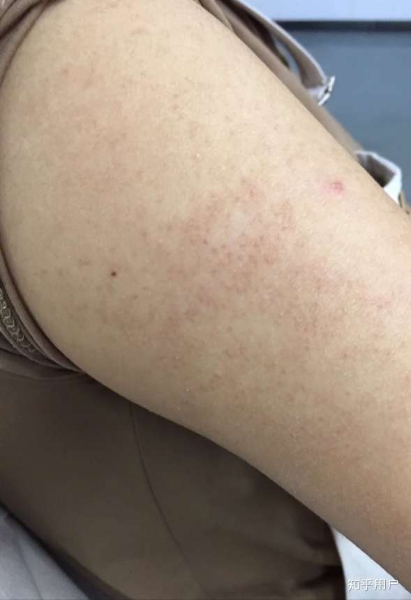 怎样去除手臂鸡皮?