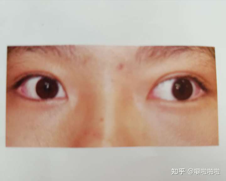 间歇性斜视,当注意力集中时,两只眼睛都会朝正前方看;当患者注意力不