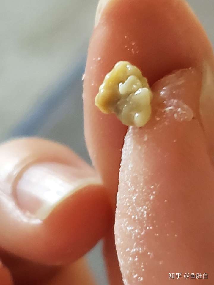 怎么预防扁桃体结石