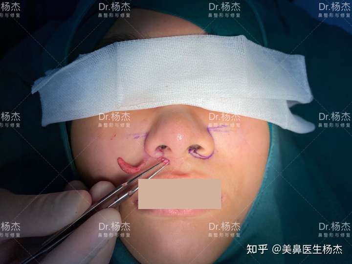 只做了鼻翼外切缩小手术的人,对术后效果还满意吗?