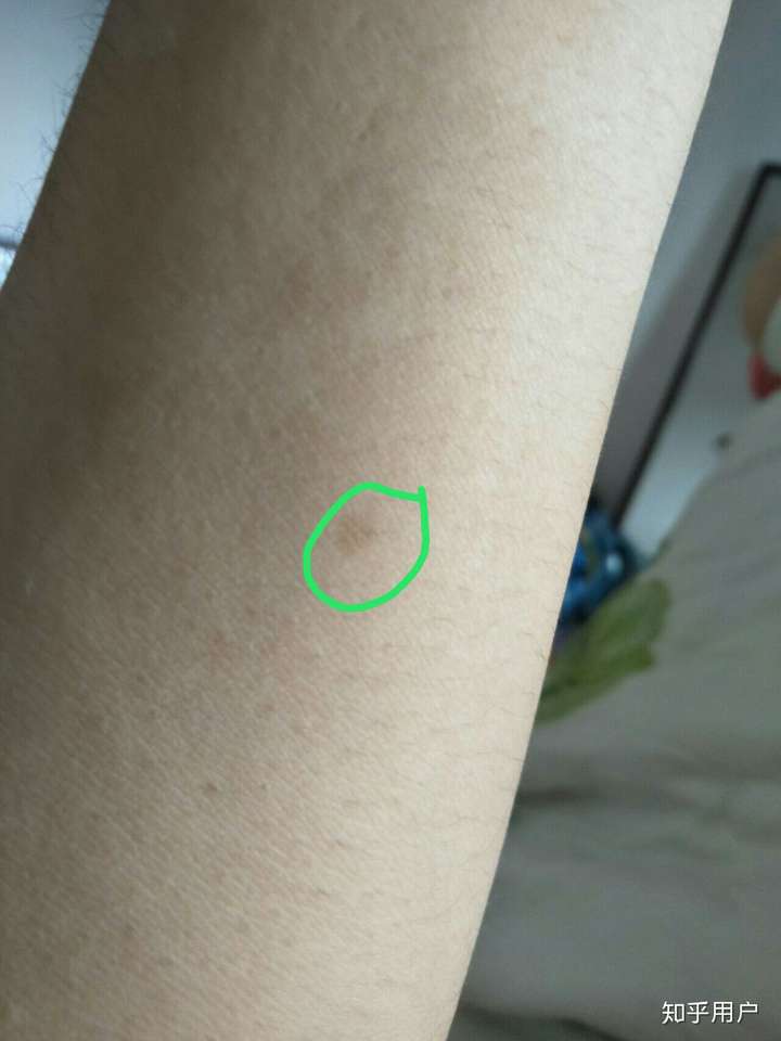你见过什么特殊的胎记?