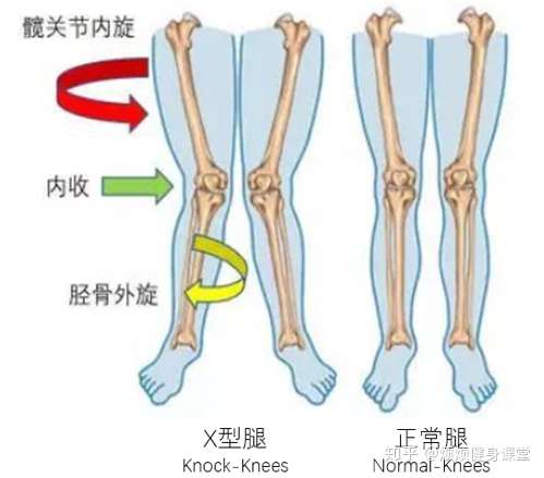 如何改善膝盖内扣