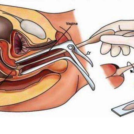 宫颈刮片检查
