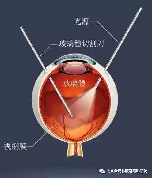 玻切示意图