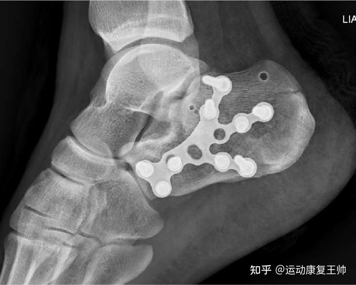 跟骨骨折二月后如何恢复训练