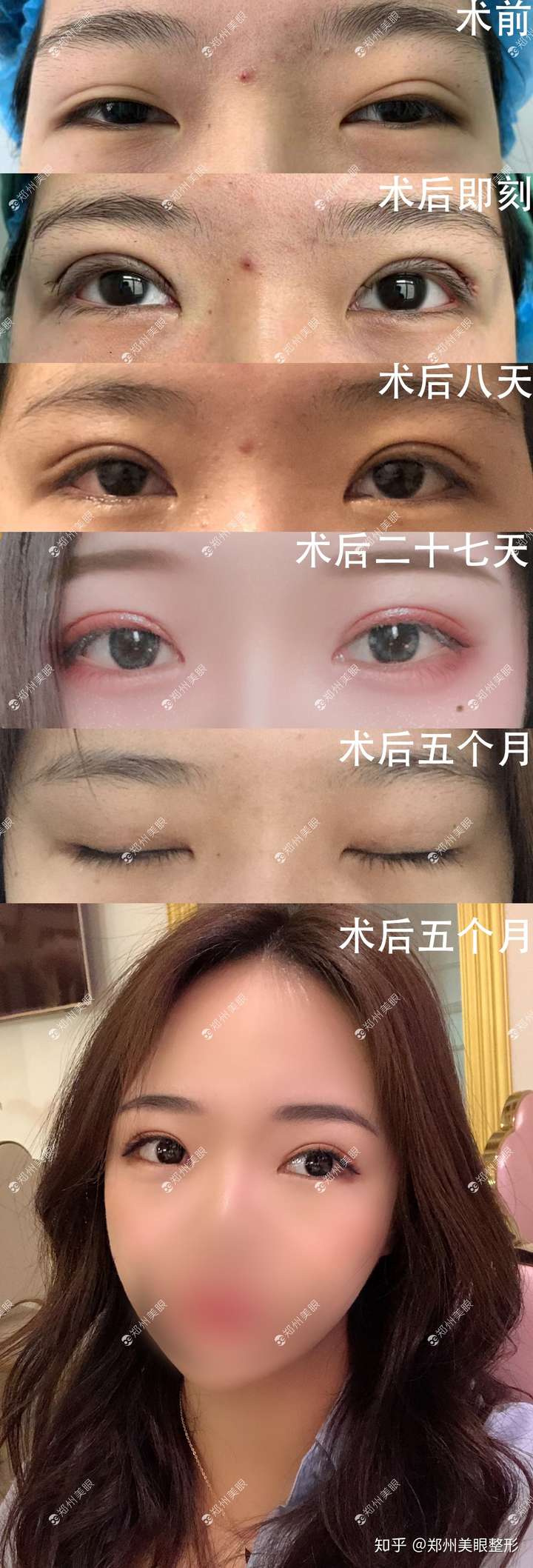 全切双眼皮术后4个月多,感觉肉条明显,褶子很深,是失败了么?