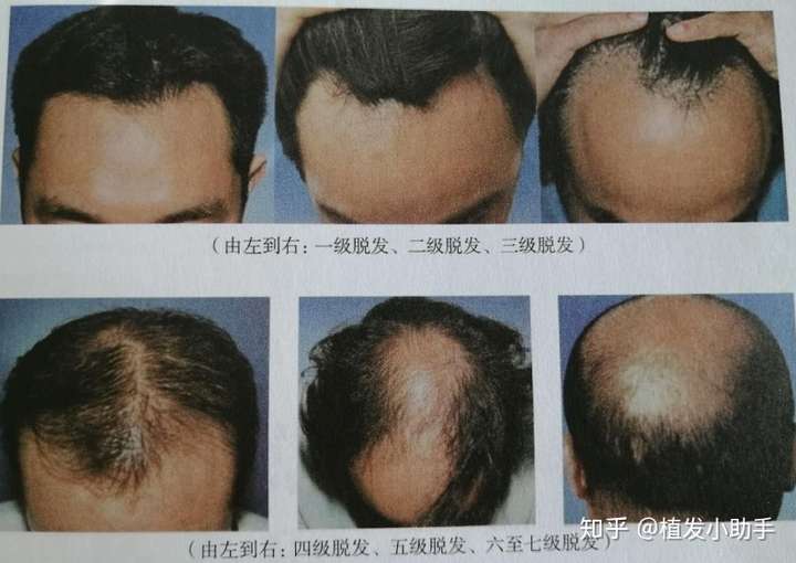 怎么分辨雄性脱发和肾虚型脱发?